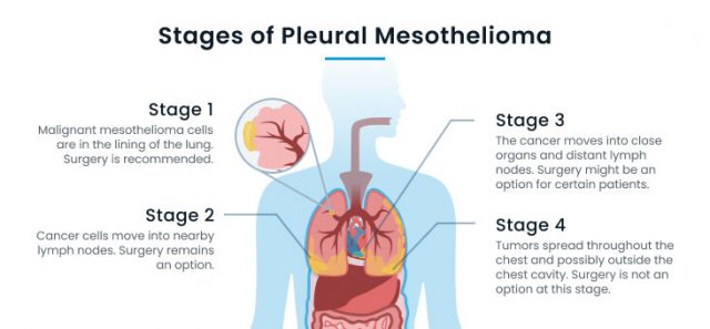 Pleural Mesothelioma Stage 4 Life Expectancy Pleural Mesothelioma Stage 4 Life Expectancy