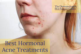 How To Treat Hormonal Acne?
